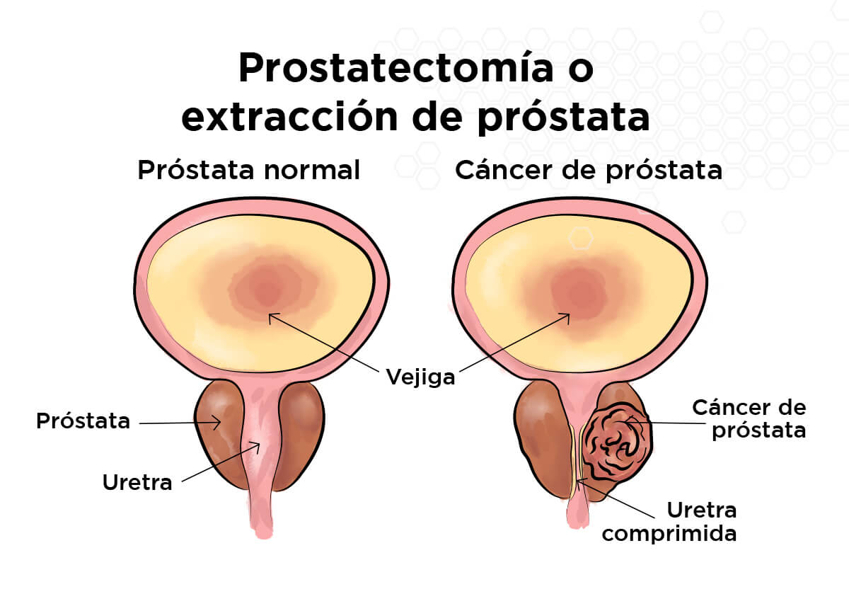 Prostatectom�a o extracci�n de pr�stata