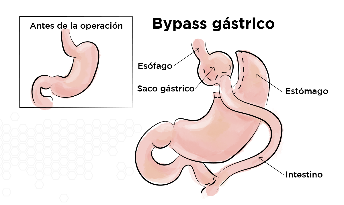 Bypass g�strico